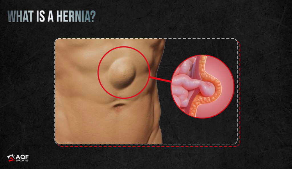 How Hernia Looks?